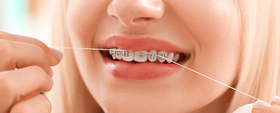 Oral hygiene tips for braces wearers