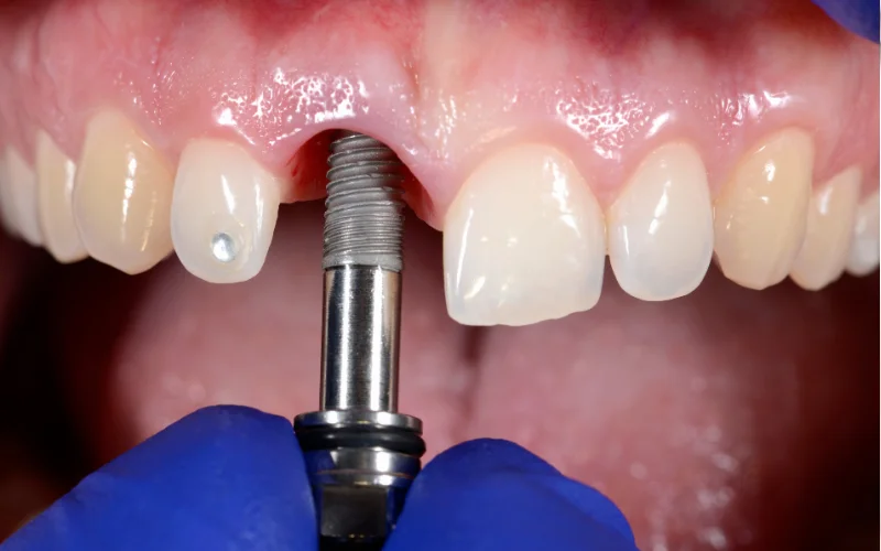 All-on-4™ Dental Implants Services - Precious Implant Dental Studio