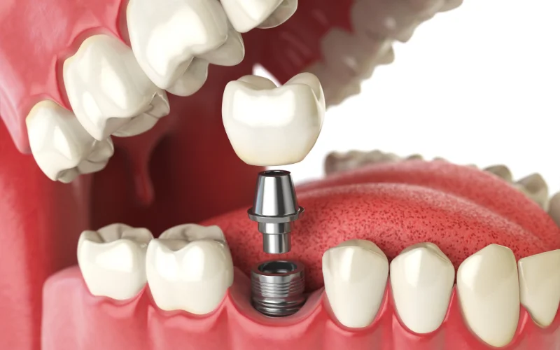 Dental Implant Services - Precious Implant Dental Studio